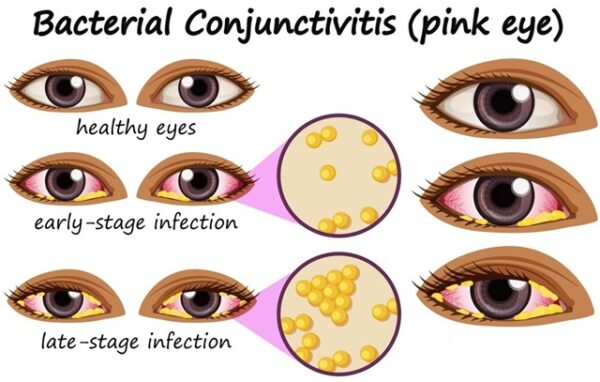 What Is Commonly Misdiagnosed As Pink Eye Myhealthtales