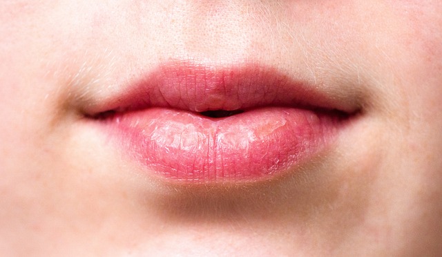 Longevity of Lip Filler