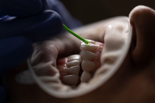 How Long Can You Keep Your Teeth With Periodontal Disease